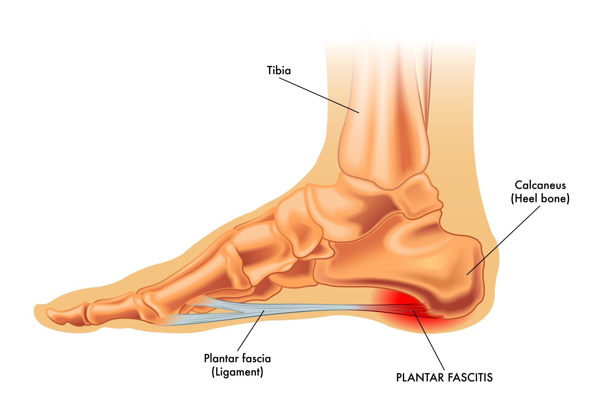 Signs of sales plantar fascia